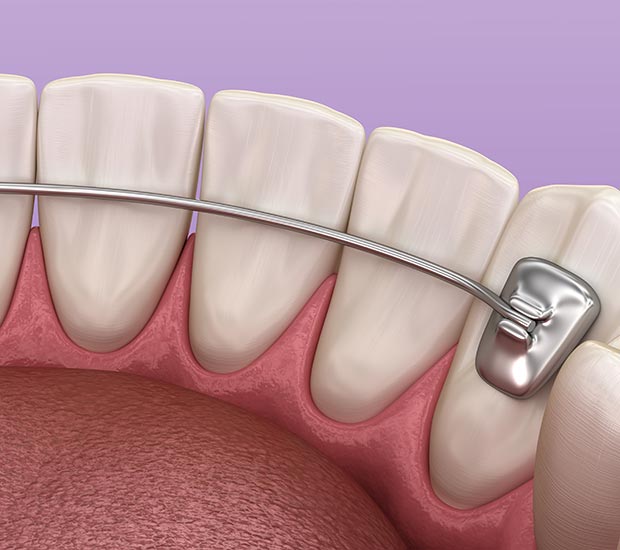 Bayport Retainers